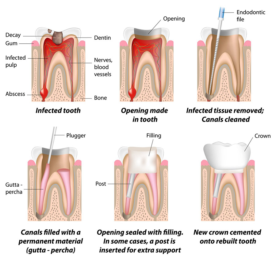 Root Canal Treatment – Procedure, Pain & Cost Explained