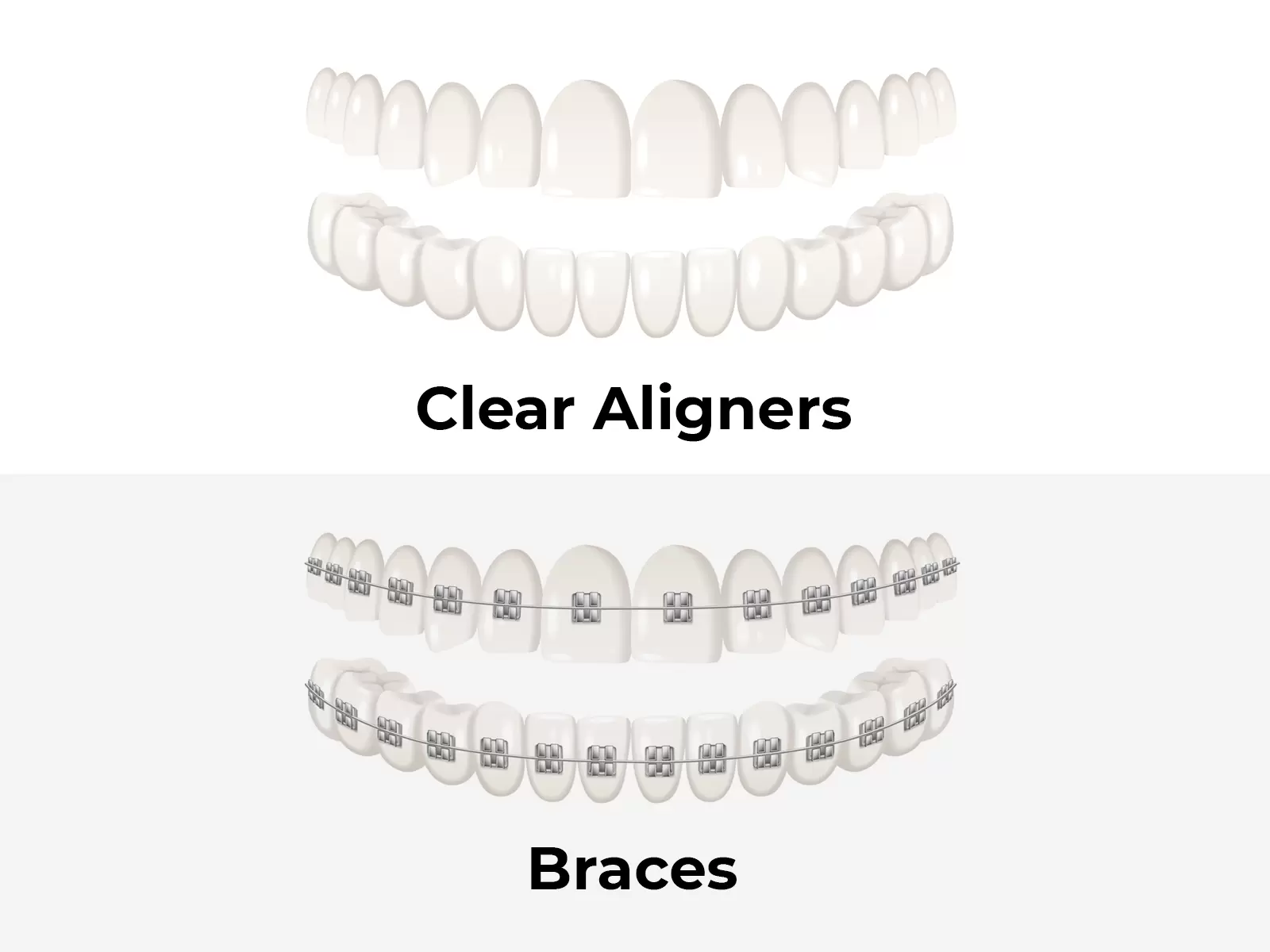 Braces vs Aligners – Which Is Better for You?