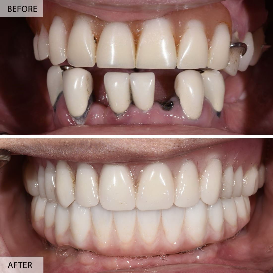 Dental Implants – Everything You Need to Know Before Choosing One