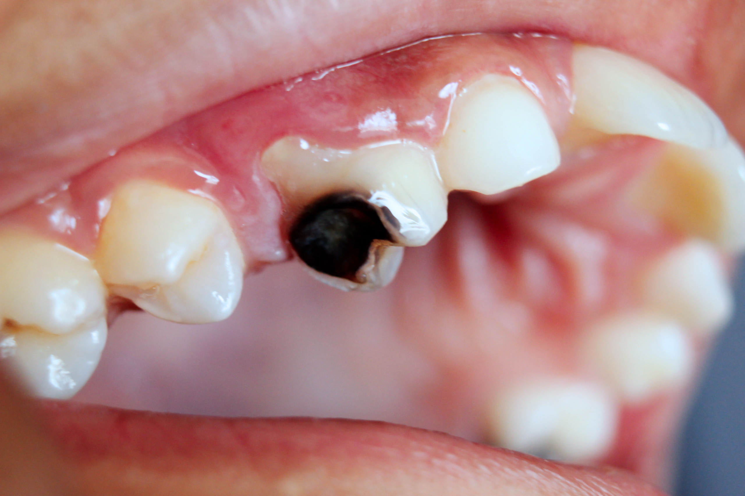 Common Dental Problems and How to Prevent Them